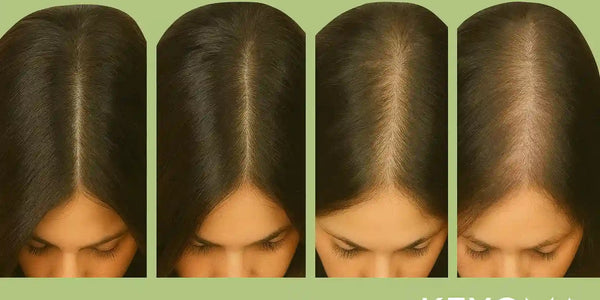 progression of female hair thinning from full, dense hair to visibly sparse coverage